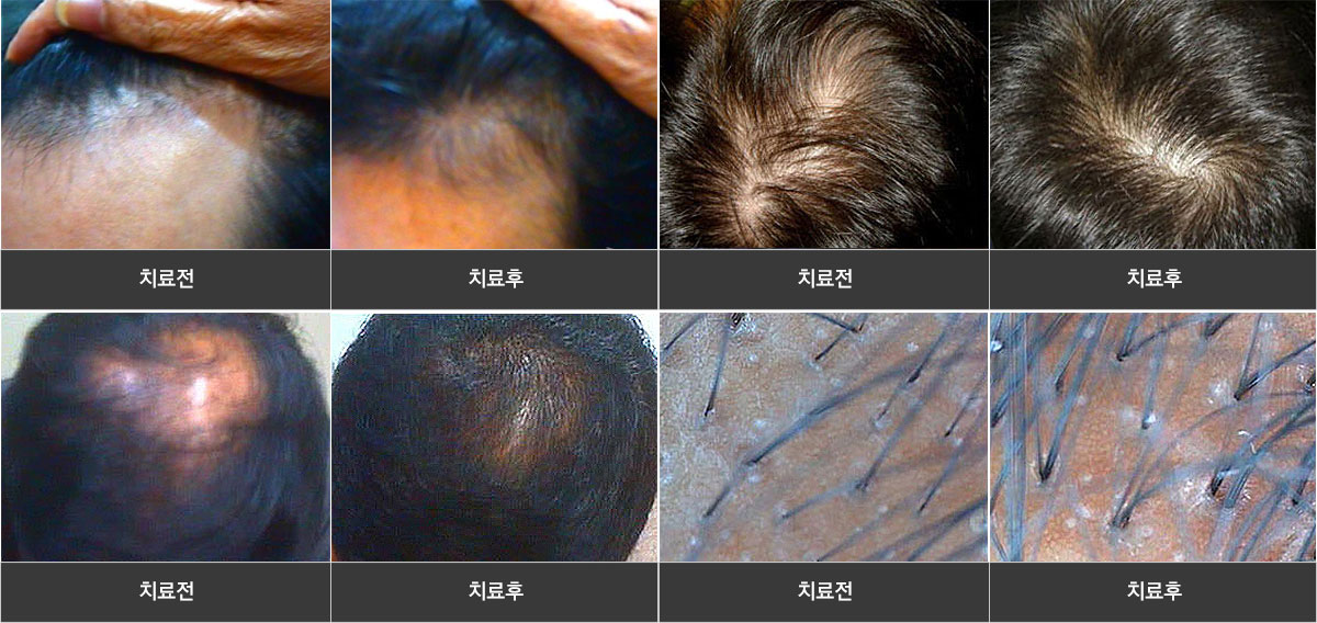 치료 전/후 사진 통 이미지